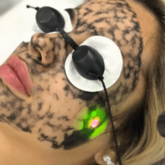 Carbon Peeling, curatarea si regenerarea tenului cu o crema peeling pe baza de carbon! Ideal pentru tenul seboreic, cu puncte negre si pori dilatati! Ridurile fine sunt diminuate, pielea isi recapata culoarea uniforma, iar tenul este mai luminos, mai tonic si porii vizibil micsorati!