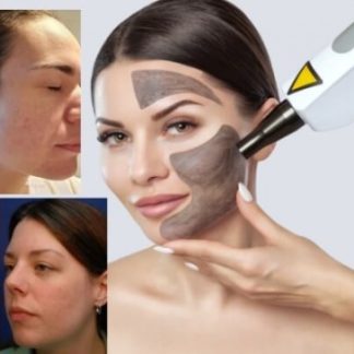 Carbon Peeling, tratament dermatologic avansat cu Laser Nd – ajuta la reducerea porilor si netezirea texturii pielii, uniformizeaza tonul pielii, reduce hiperpigmentarea, reda stralucirea, curata in profunzime si reduce inflamatiile. Rezultate rapide, fara timp de recuperare! Rejuvenare&Regenerae