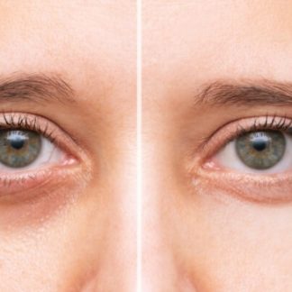 Cearcane, ochi umflati, riduri? Alege Teosyal Redensity II sau Mezoterapie Acid Hialuronic nereticulat – desemnat cel mai bun produs injectabil pentru zona ochilor! Rezultate instant de hidratare, biorevitalizare, anti-rid, diminuarea cercanelor profunde si a edemelor!