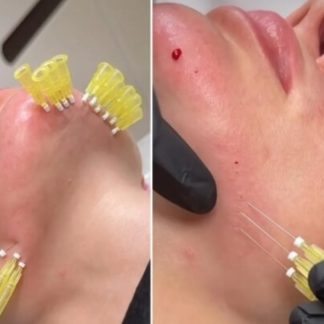 Contur mandibular cu fire PDO si seringa Mezo! Procedura perfecta pentru a reface conturul mandibular si a armoniza trasaturile faciale. Contureaza si redefineste zona mandibulara, reduce aspectul flasc al pielii, ofera contur ferm.