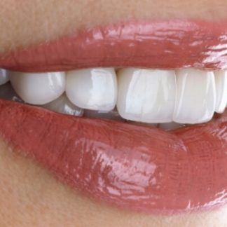 Coroana dentara - pachet complet pentru o dantura sanatoasa! Dinte spart, rupt sau o carie complicata? Scapa de probleme cu oferta noastra! Protejeaza-ti dintii si mergi la stomatolog! Oferta include consultatie, plan de tratament, coroana dentara, cimentare provizorie si definitiva.